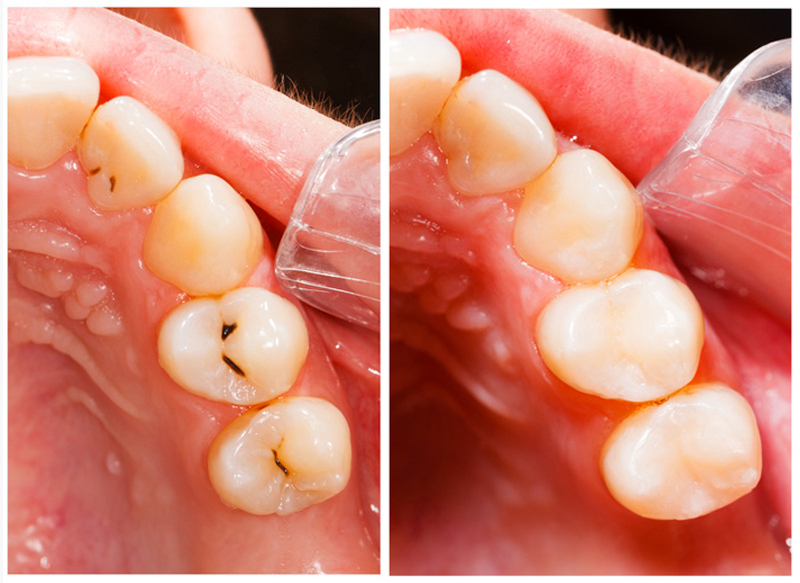 Fillings Glen Carbon, IL